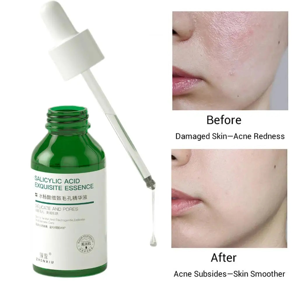 Salicylic Acid Pore Shrinking Essence Anti-acne Exfoliating Blackhead Remover Face Spot Removal Essence Beauty Health Skin Care