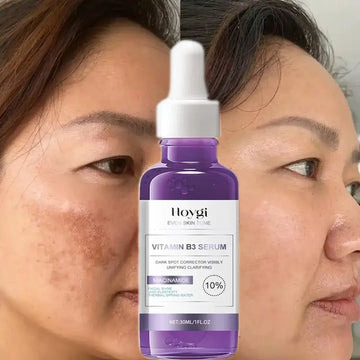 Dark Spot Remover Serum – Korean Anti-Pigmentation Whitening