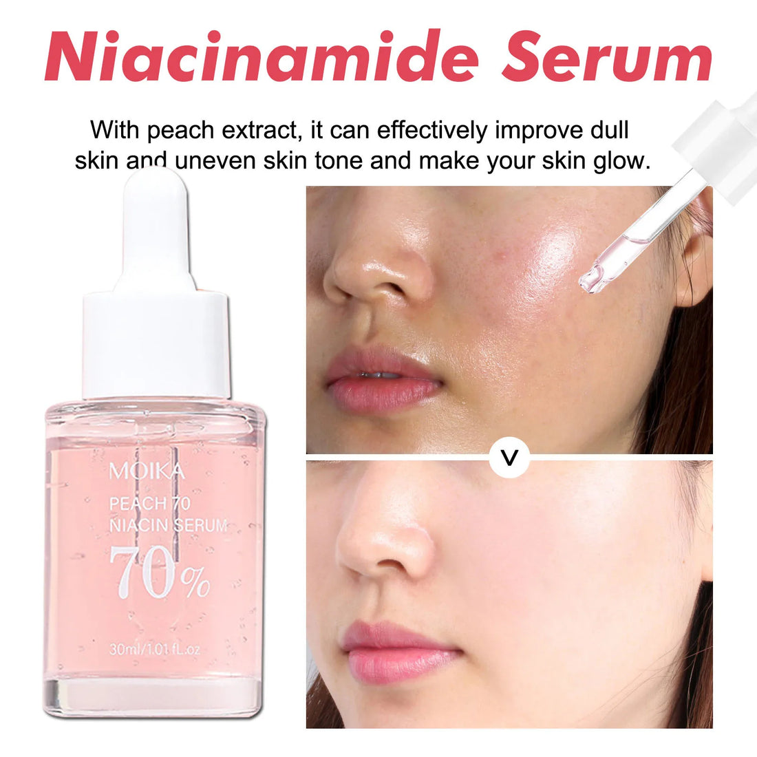 Niacinamide Serum Dark Spot Remover Fade Acne Marks Hyperpigmentation Shrink Pores